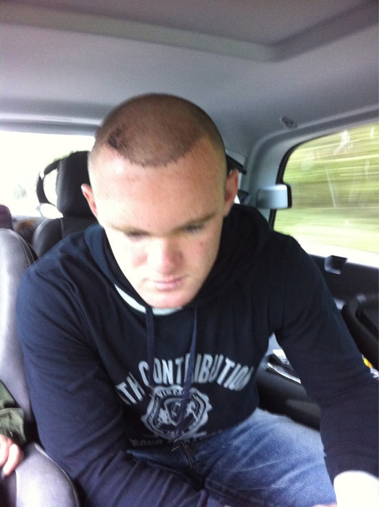 Wayne Rooney hair transplant
