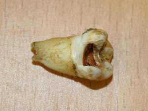John Lenoon's tooth