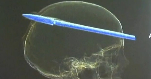 Teenager survives harpoon to head