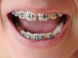 Teeth fitted with dental braces