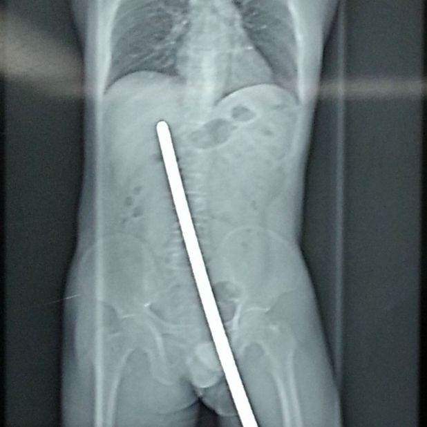 Man Survives Being Impaled On Metal Bar Picture Fun News Digital Spy